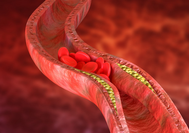 atherosclerosis-is-accumulation-cholesterol-plaques-walls-arteries_59529-671 (1)