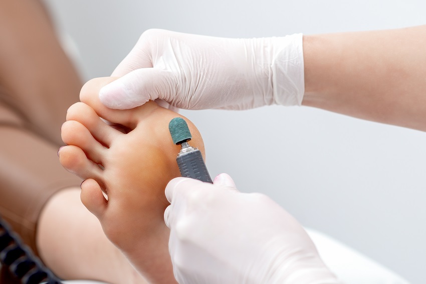 Peeling feet pedicure procedure on foot