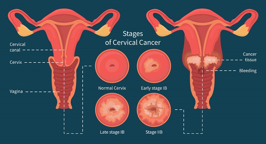 Stages of woman cervical cancer infographic scheme