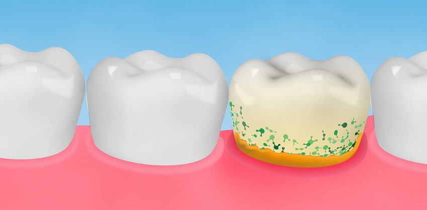 Dental calculus with bacteria. Colorful vector illustration.