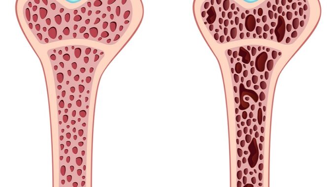 osteoporoza