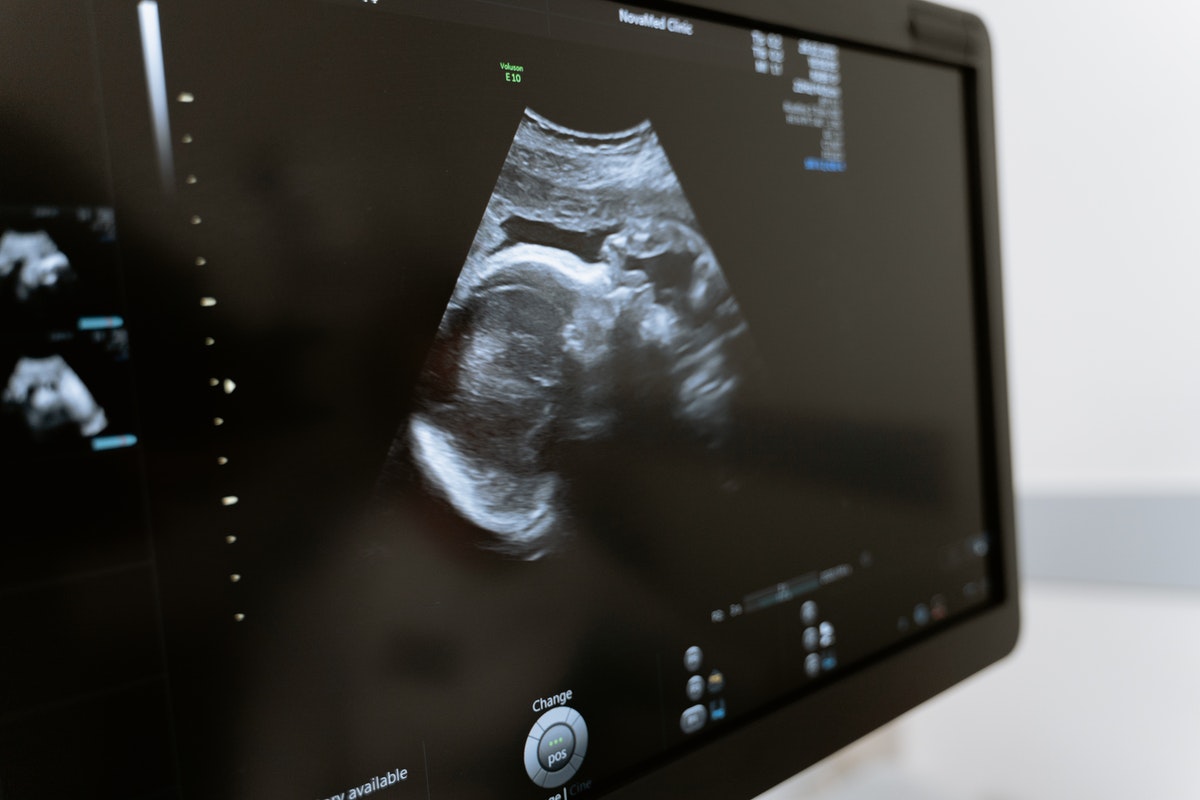 ultrazvuk-miminko
